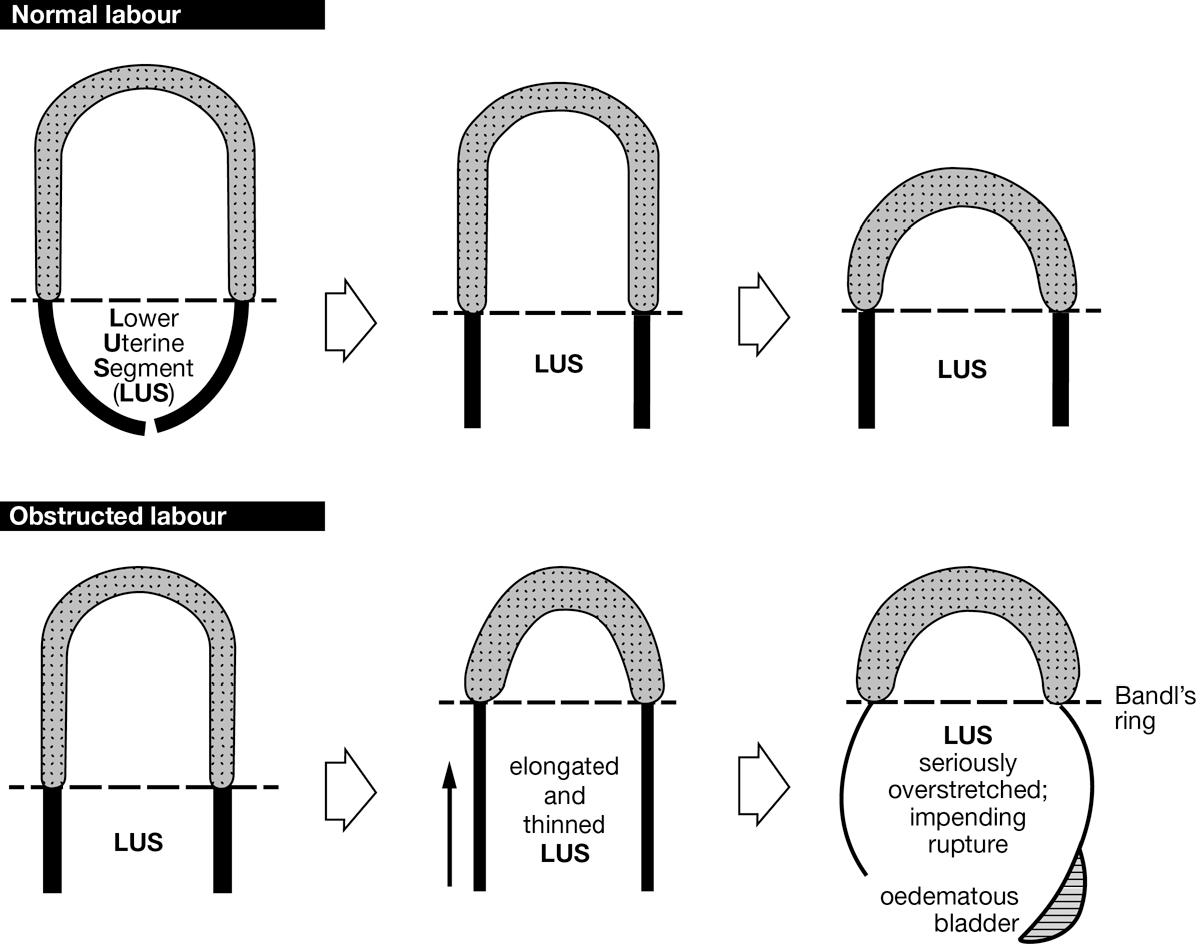 THE PRESENT-DAY STATUS OF THE CONSTRICTIO RI GS OF LABOUR