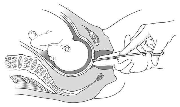 5-3-artificial-rupture-of-the-membranes-msf-medical-guidelines