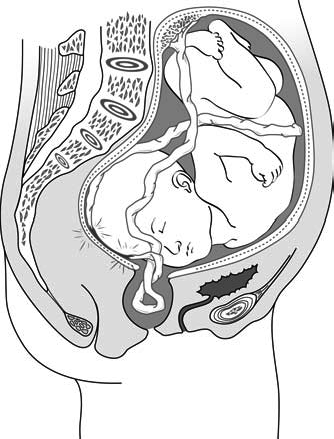 Accouchement normal (procédure) — Wikimedica