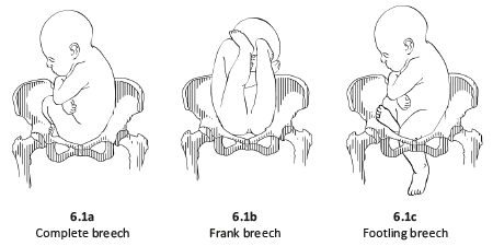 how to deliver breech presentation