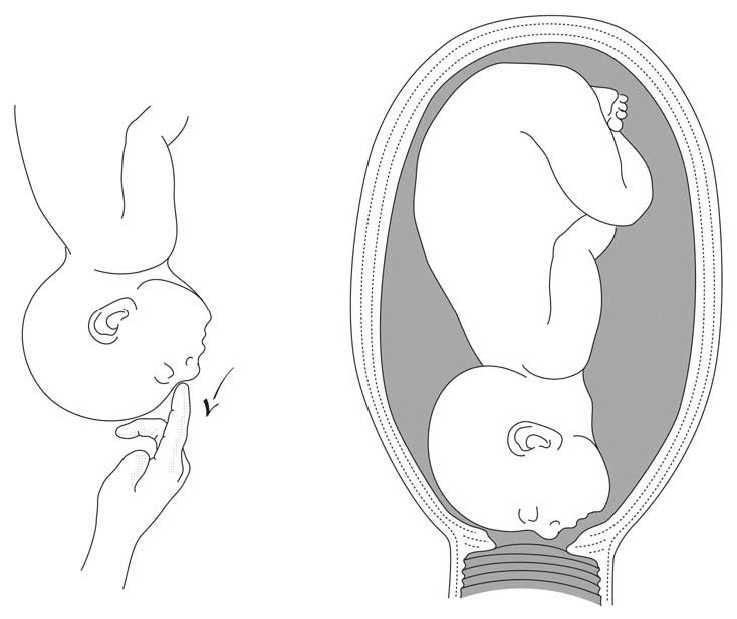 mode of delivery in brow presentation