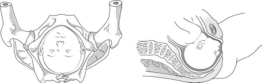 cesarean delivery in face presentation