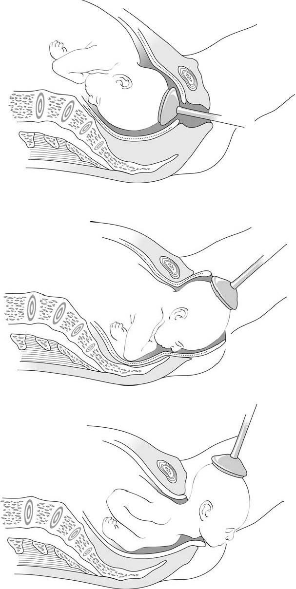 الشدّ بالاستخراج بالتخلية (آلة الشفط (الممحجم)): يختلف محور الشدّ تبعًا لتقدم رأس الجنين