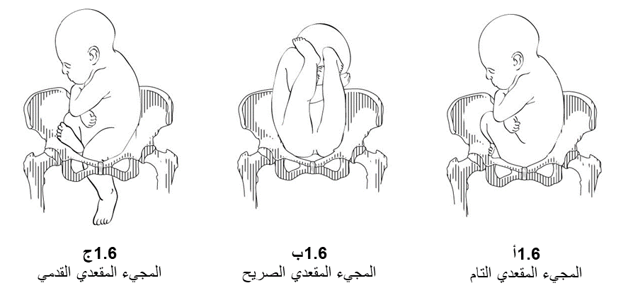 الأشكال 1.6 - أنماط المجيء المقعدي